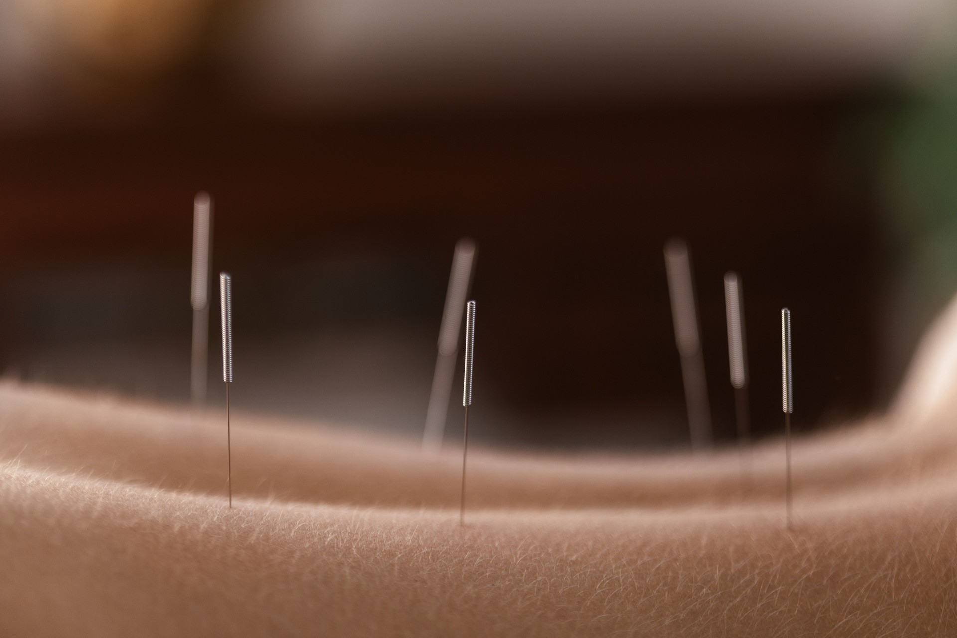 Acupuncture for peak performance, boosting strength and flexibility