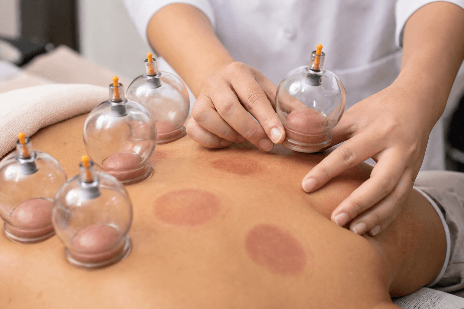 Cupping therapy at Windsor clinic — serving Windsor area patients