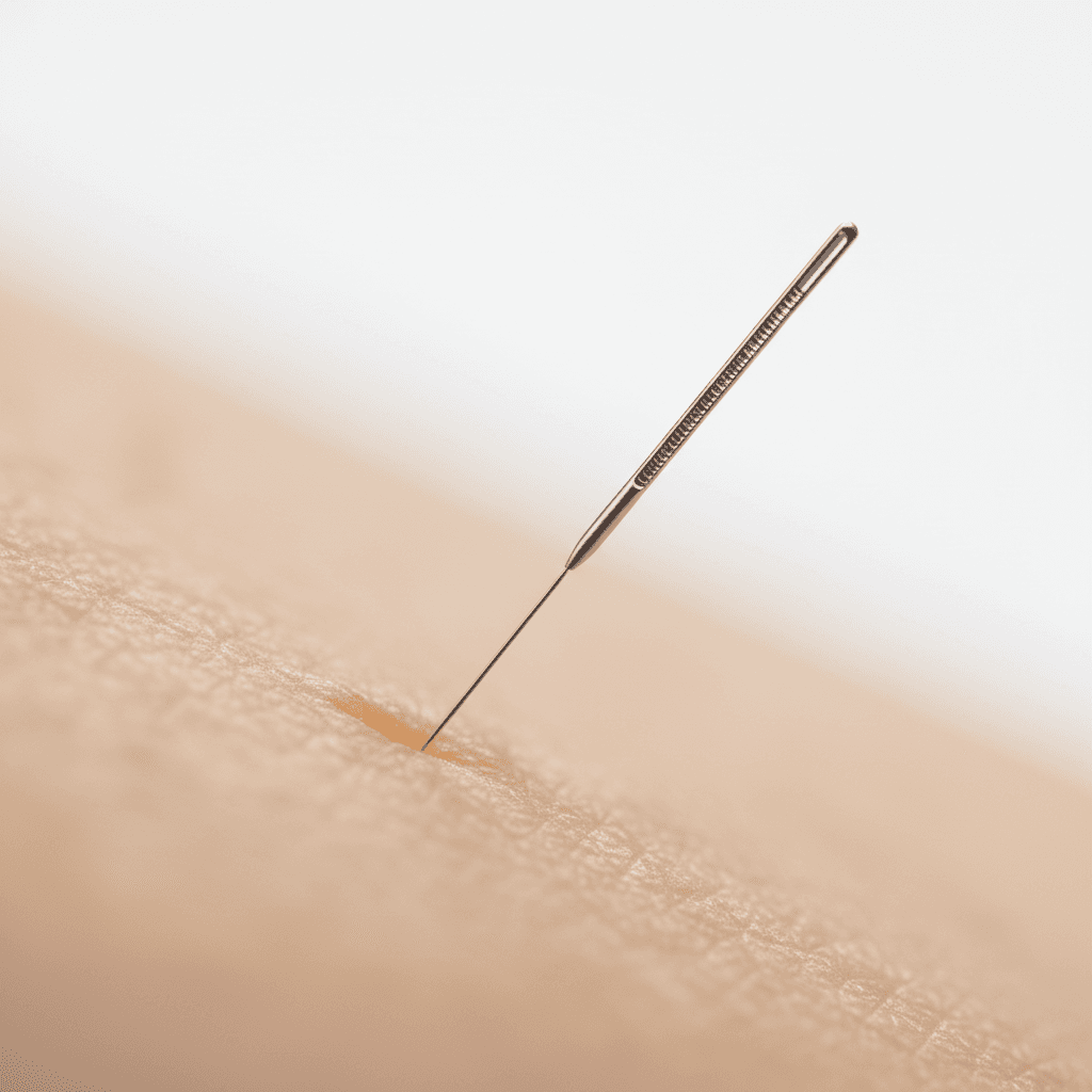 Close-up of acupuncture needle at motor point